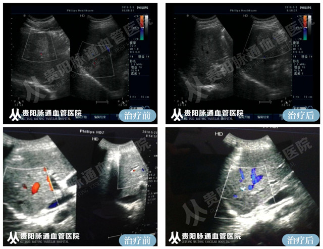 【贵阳血管瘤治疗案例】智能腔内综合治疗前后对比5